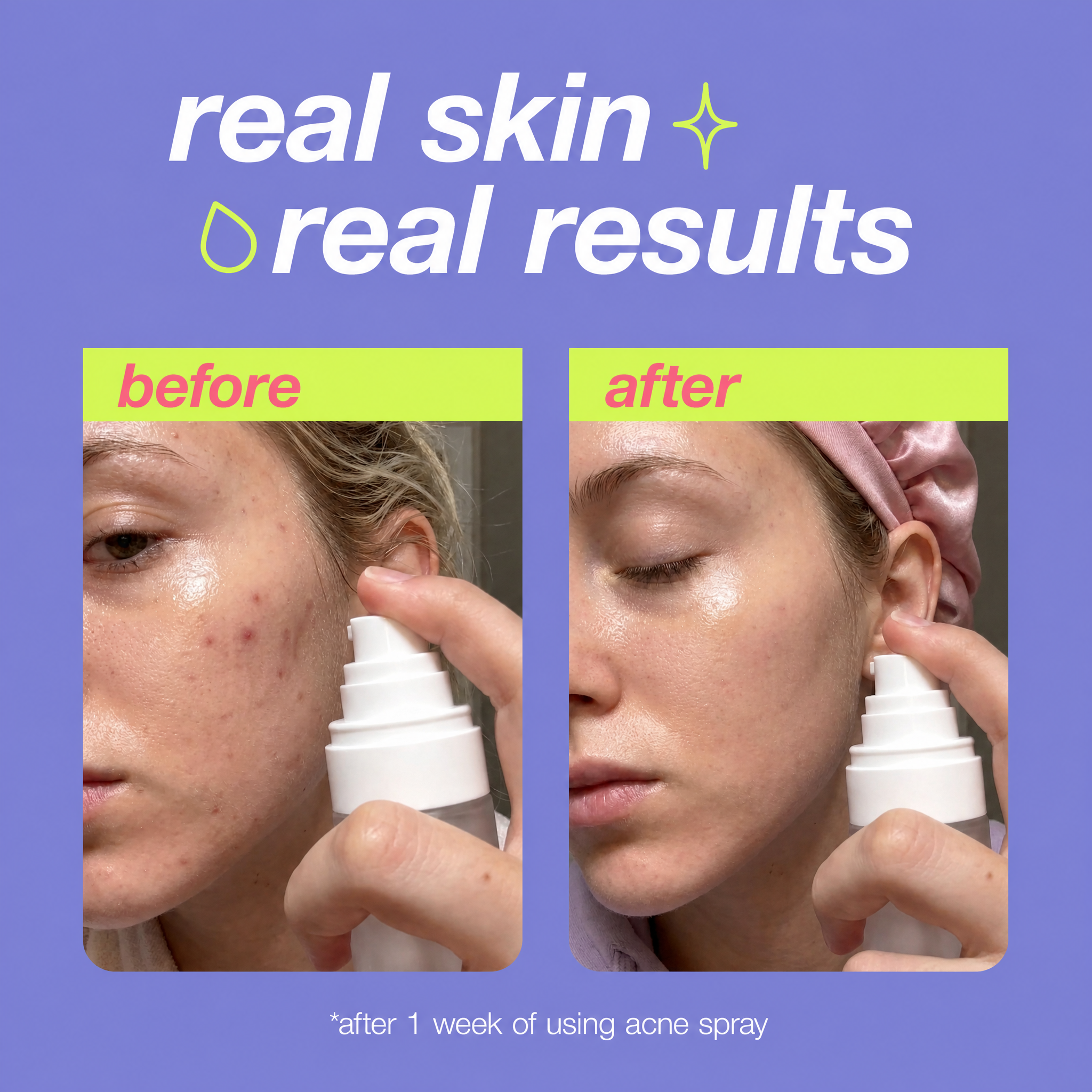 Silkiee Acne Spray